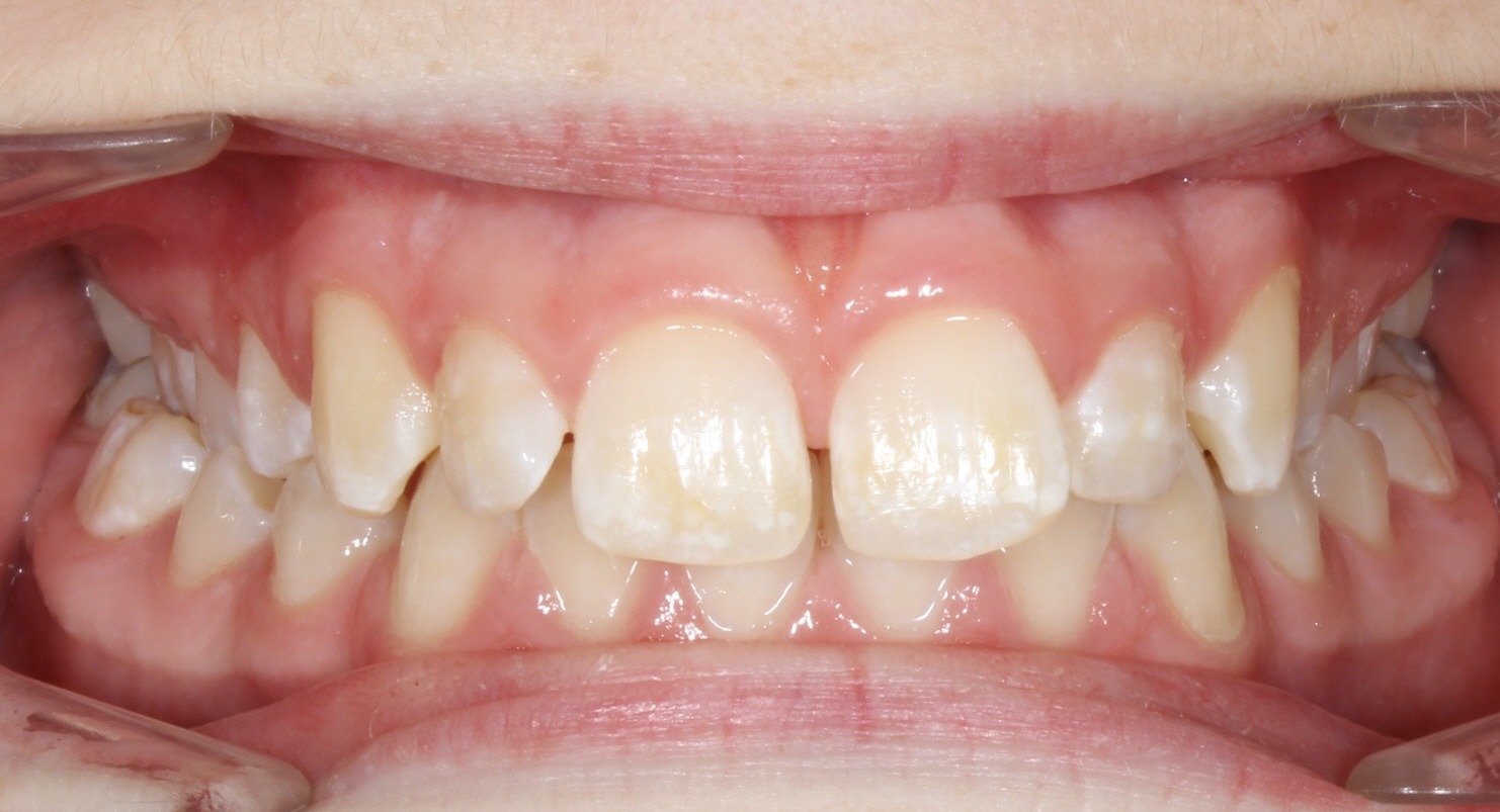 before Image