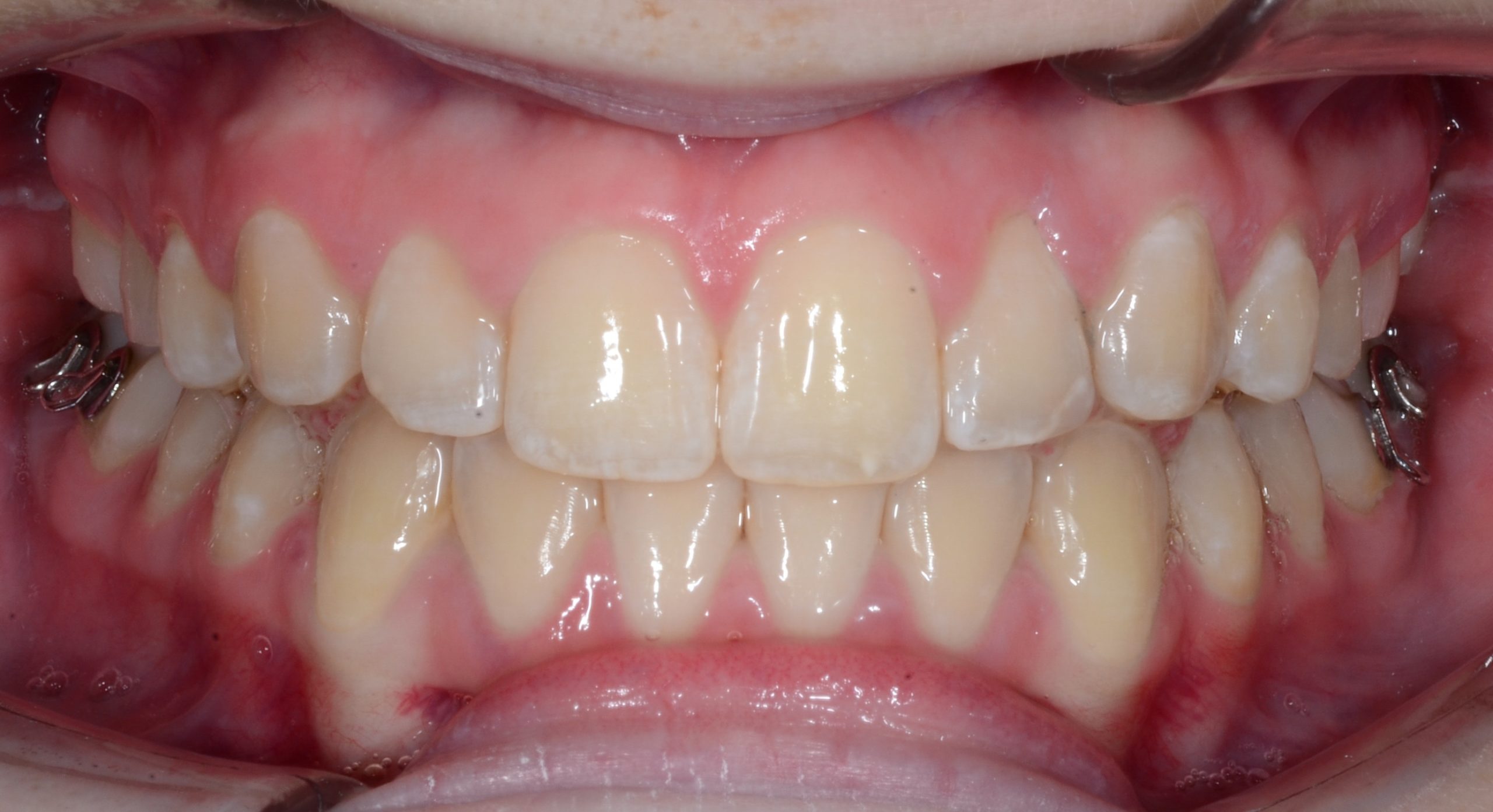 after Image
