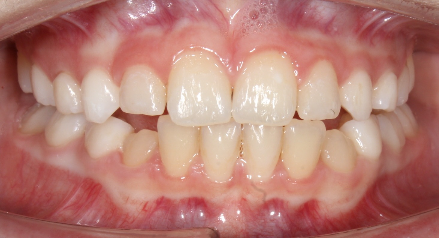 after Image