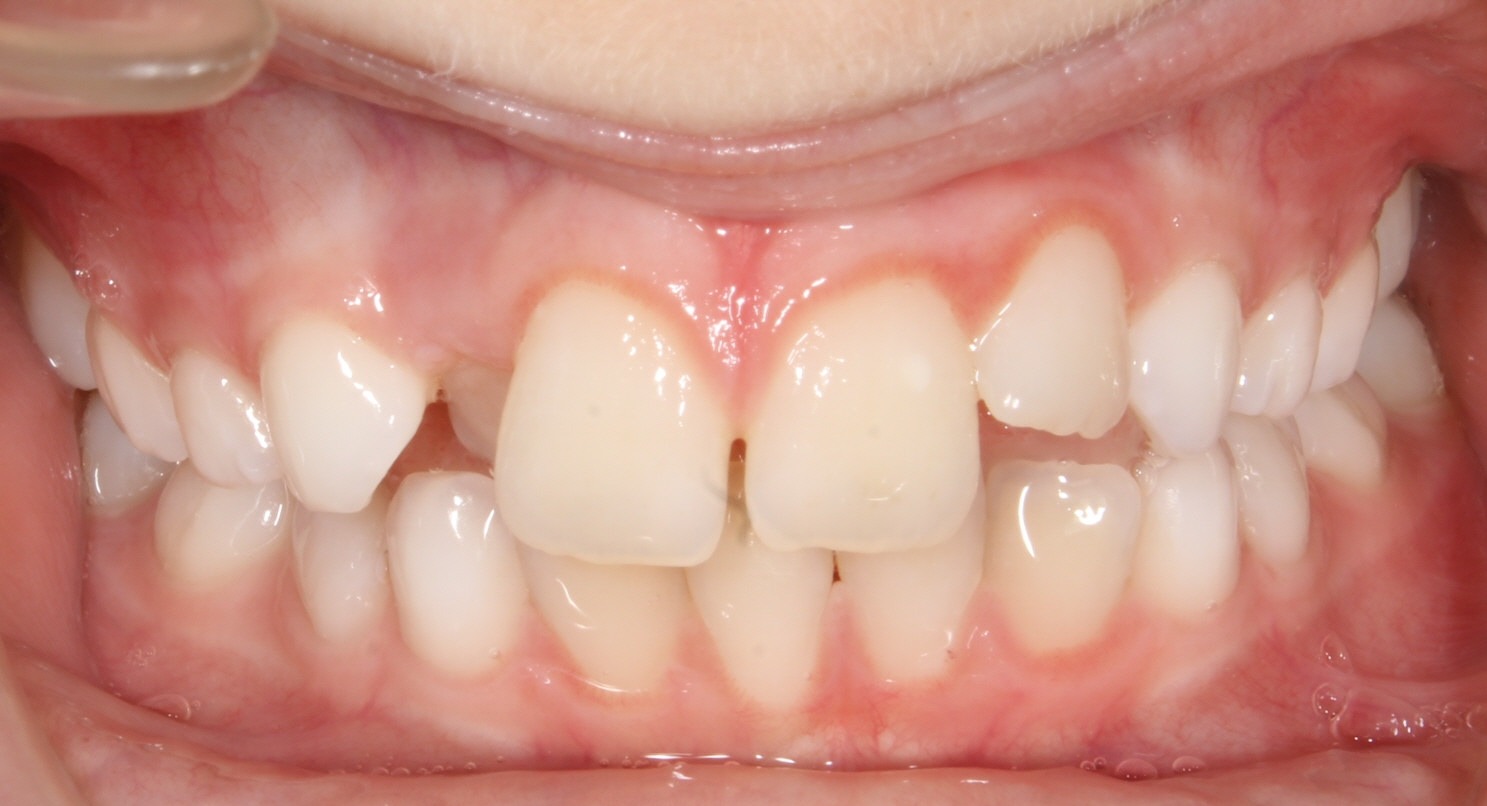 before Image