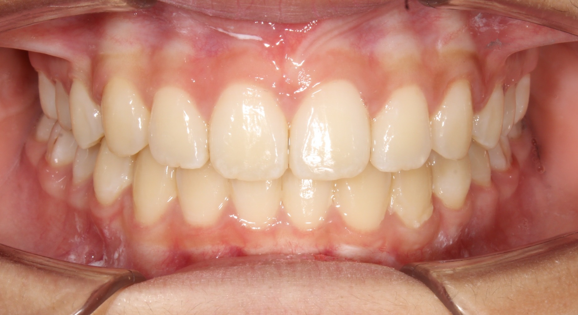 after Image