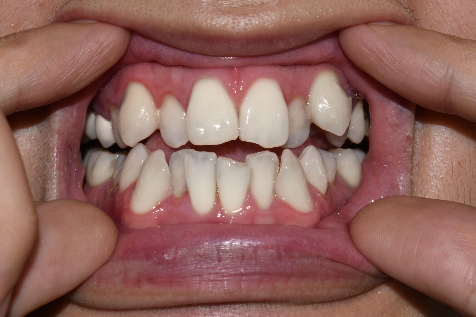 braces orthodontist edmond