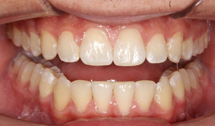 Invisalign For Teens orthodontic treatment after - patient 1
