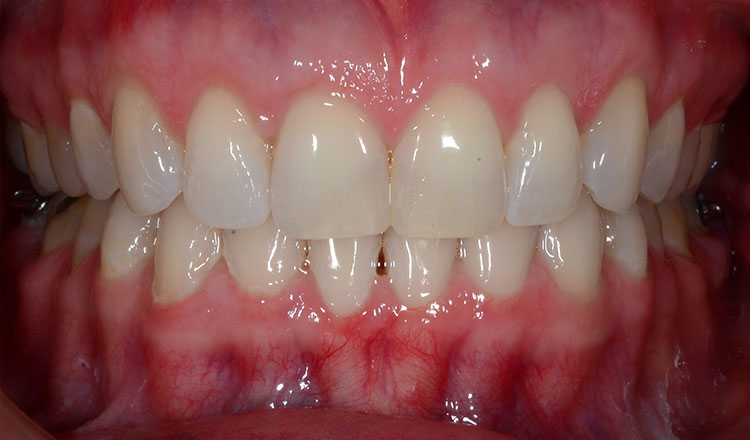 Invisalign For Adults orthodontic treatment after - patient 1