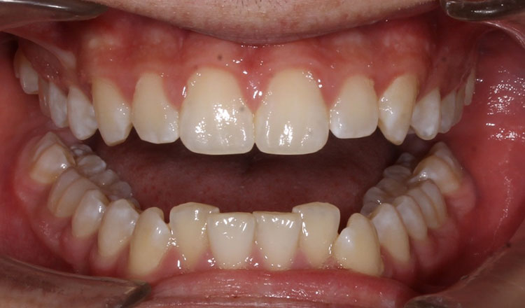 Invisalign For Teens orthodontic treatment before - patient 1