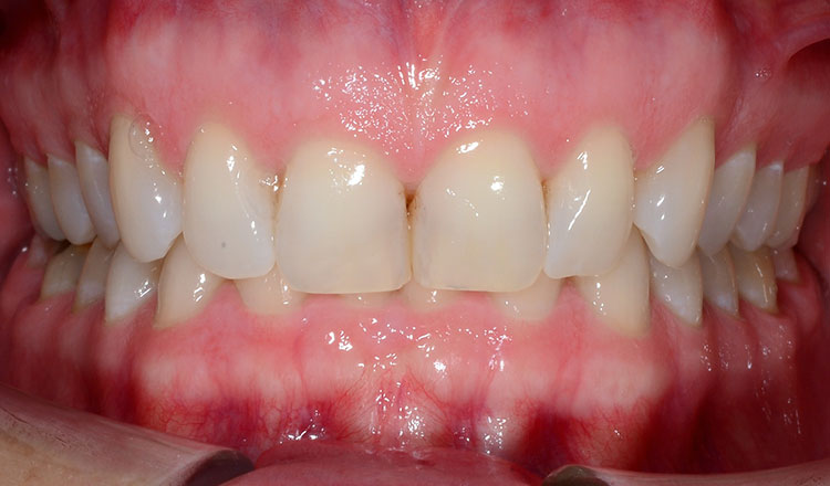 Invisalign For Adults orthodontic treatment before - patient 1