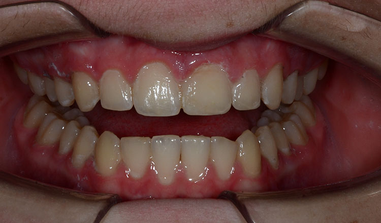 Invisalign For Teens orthodontic treatment after - patient 2