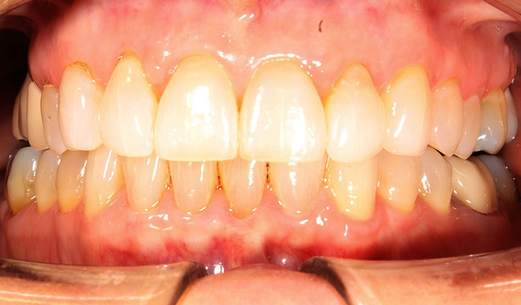 Invisalign For Adults orthodontic treatment after - patient 2