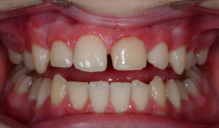 Invisalign For Teens orthodontic treatment before - patient 2