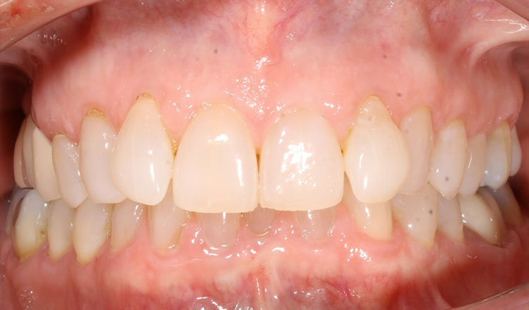 Invisalign For Adults orthodontic treatment before - patient 2