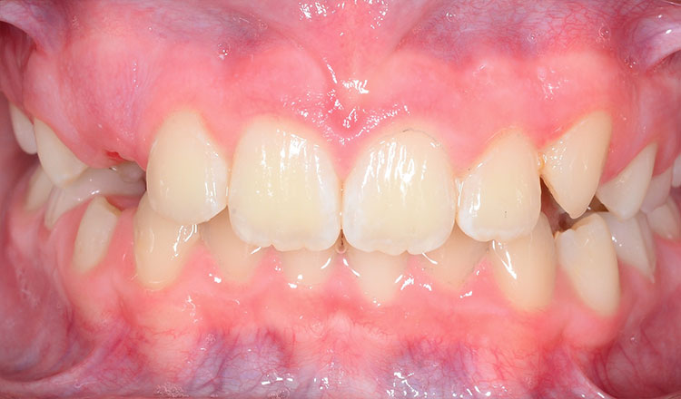 Invisalign First orthodontic treatment after - patient 3
