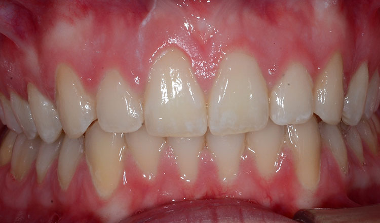 Invisalign For Teens orthodontic treatment after - patient 3