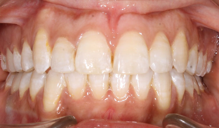 Invisalign For Adults orthodontic treatment after - patient 3