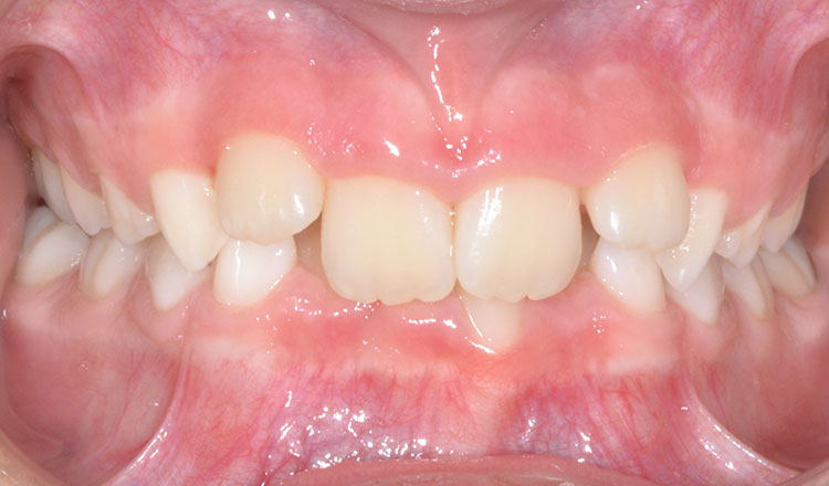Invisalign First orthodontic treatment before - patient 3