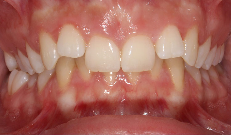 Invisalign For Teens orthodontic treatment before - patient 3