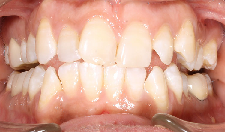 Invisalign For Adults orthodontic treatment before - patient 3