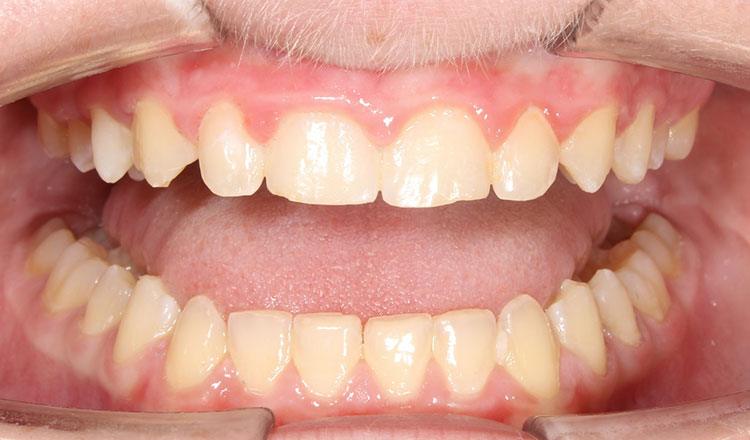 Invisalign For Teens orthodontic treatment after - patient 4