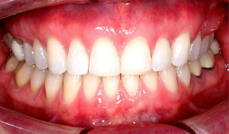 Invisalign For Adults orthodontic treatment after - patient 4
