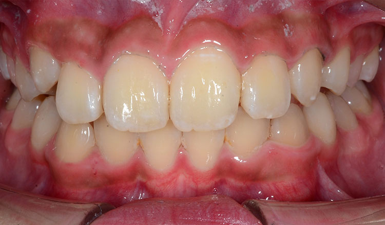Invisalign First orthodontic treatment after - patient 4