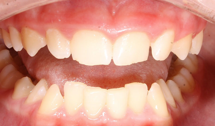 Invisalign For Teens orthodontic treatment before - patient 4