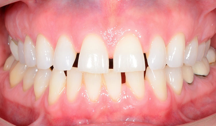 Invisalign For Adults orthodontic treatment before - patient 4