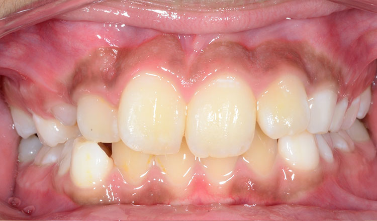 Invisalign First orthodontic treatment before - patient 4