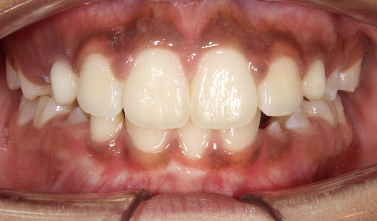 Invisalign First orthodontic treatment after - patient 5