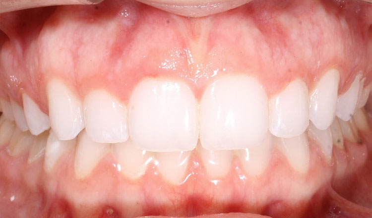 Invisalign For Adults orthodontic treatment after - patient 5