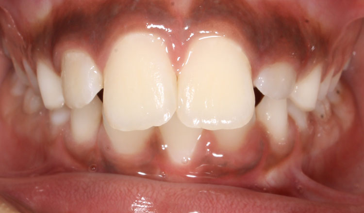 Invisalign First orthodontic treatment before - patient 5