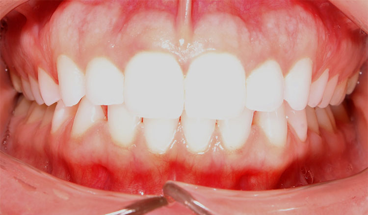 Invisalign For Adults orthodontic treatment before - patient 5