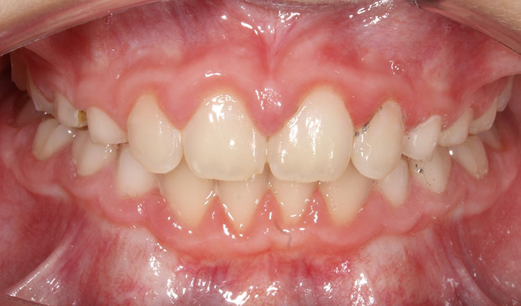 Invisalign First orthodontic treatment after - patient 6