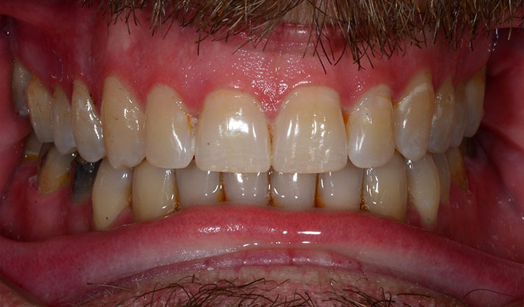 Invisalign For Adults orthodontic treatment after - patient 6
