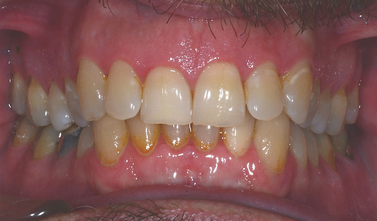 Invisalign For Adults orthodontic treatment before - patient 6