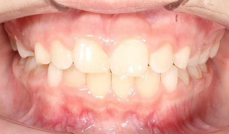 Invisalign First orthodontic treatment after - patient 7