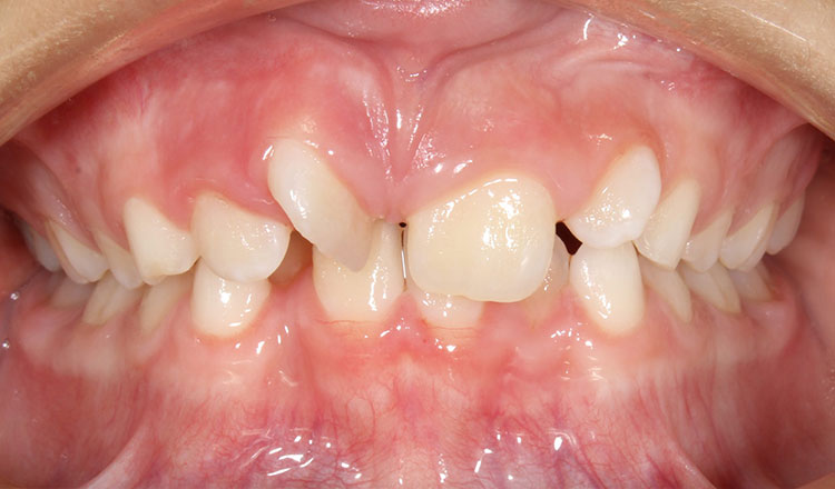 Invisalign First orthodontic treatment before - patient 7
