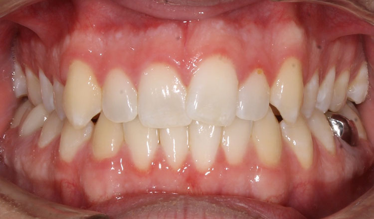 Invisalign For Adults orthodontic treatment before - patient 7